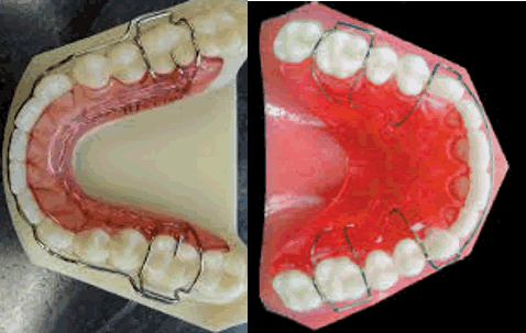 Lack_of_occlusal_coverage.gif