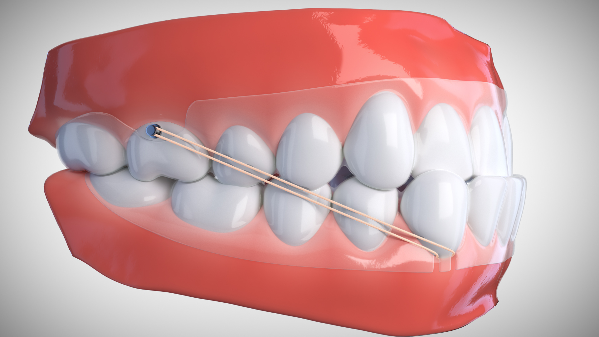 Icc.2281_en_01_Cutout_Class III_Button e Slit_Aligner.jpg