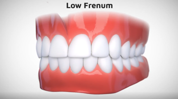 LowTrimline_04.png